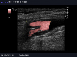 Ultrazvok vratnih žil - aterosklerotični plak v notranji karotidni arteriji